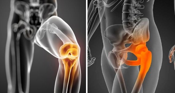 Opciones de tratamiento en artrosis de cadera y rodilla – Trauma Advance